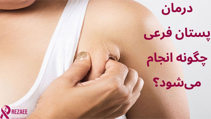 درمان پستان اضافه