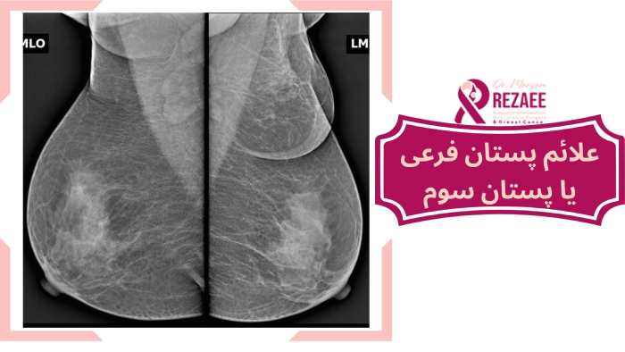 علائم پستان سوم