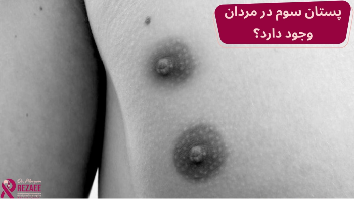 پستان سوم در مردان